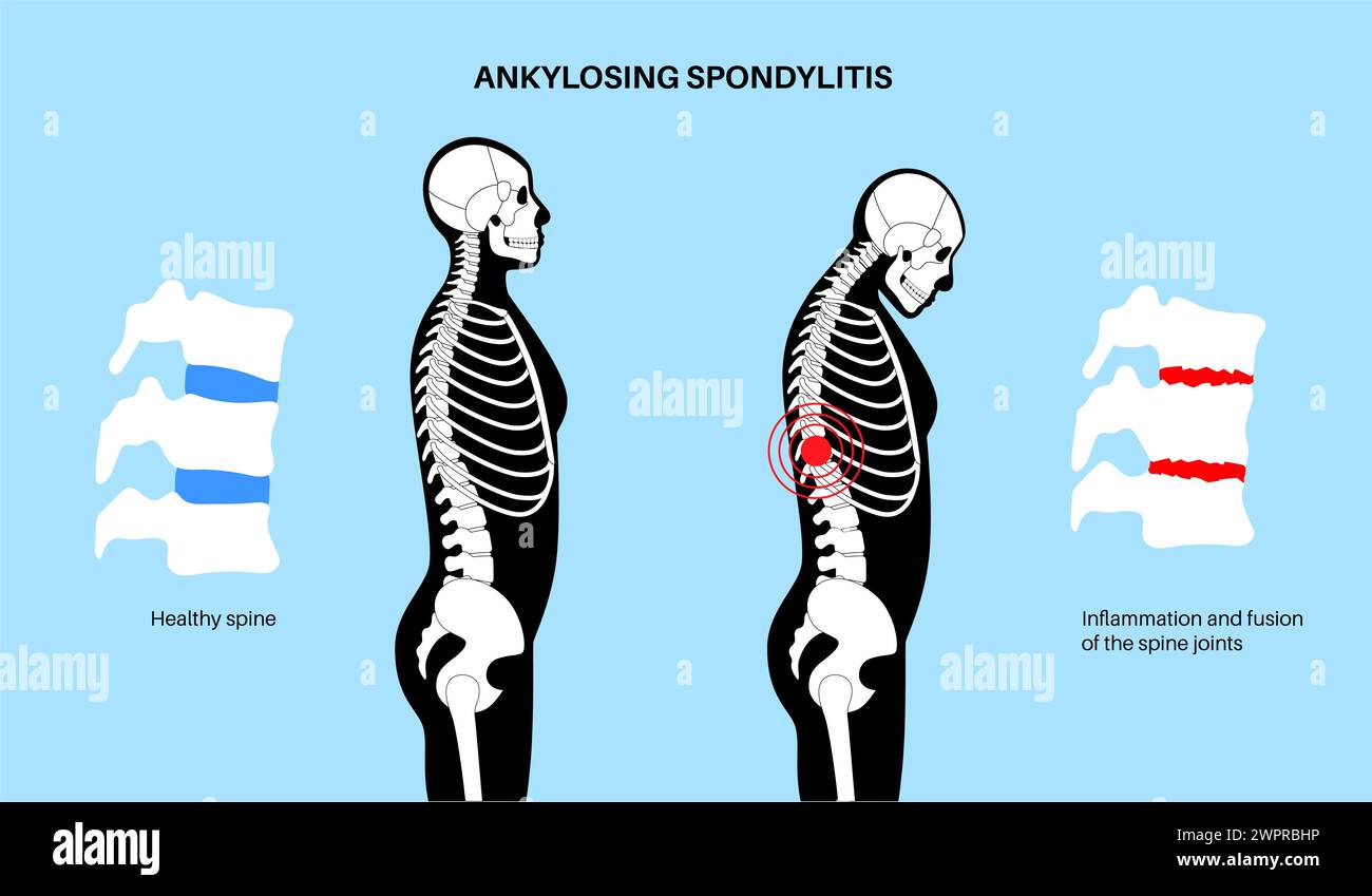 Spondylitis ankylosans, Illustration Stockfoto