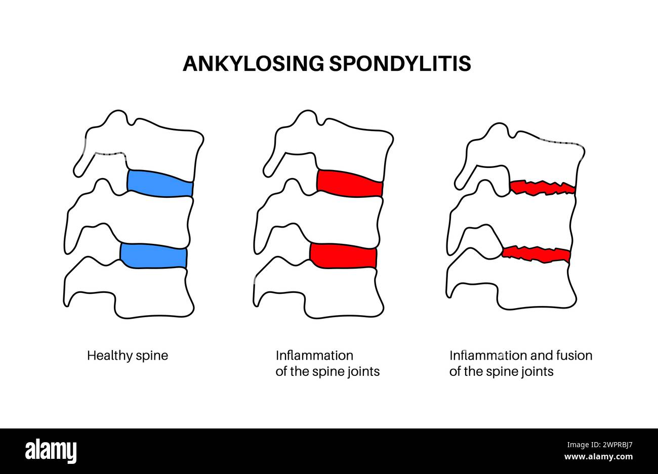 Spondylitis ankylosans, Illustration Stockfoto