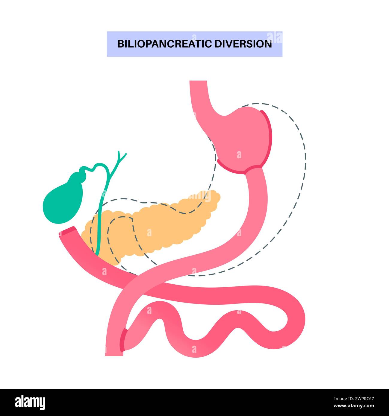 Biliopankreatische Umleitungsverfahren, Illustration Stockfoto