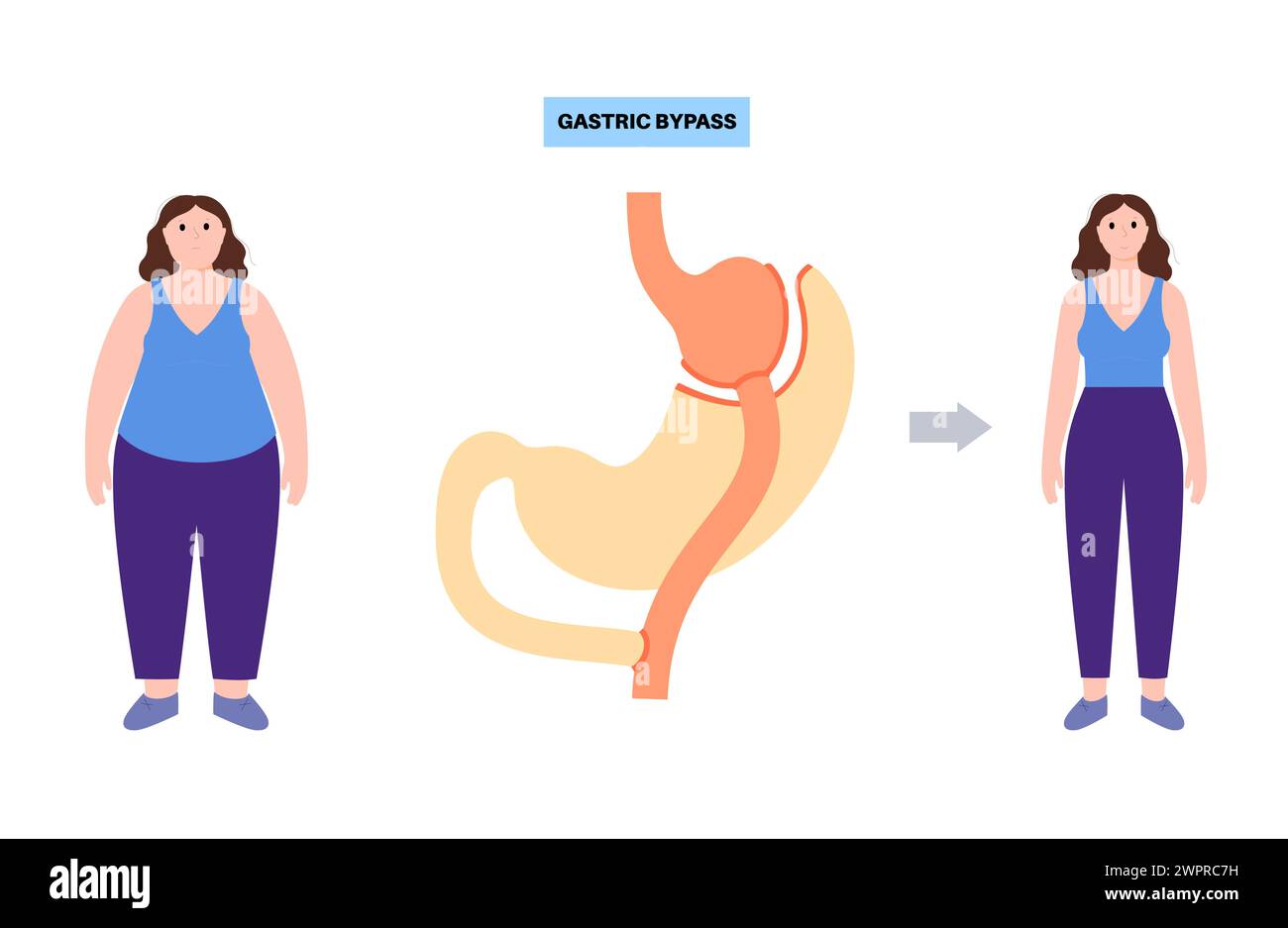 Magenbypass-Chirurgie, Illustration Stockfoto