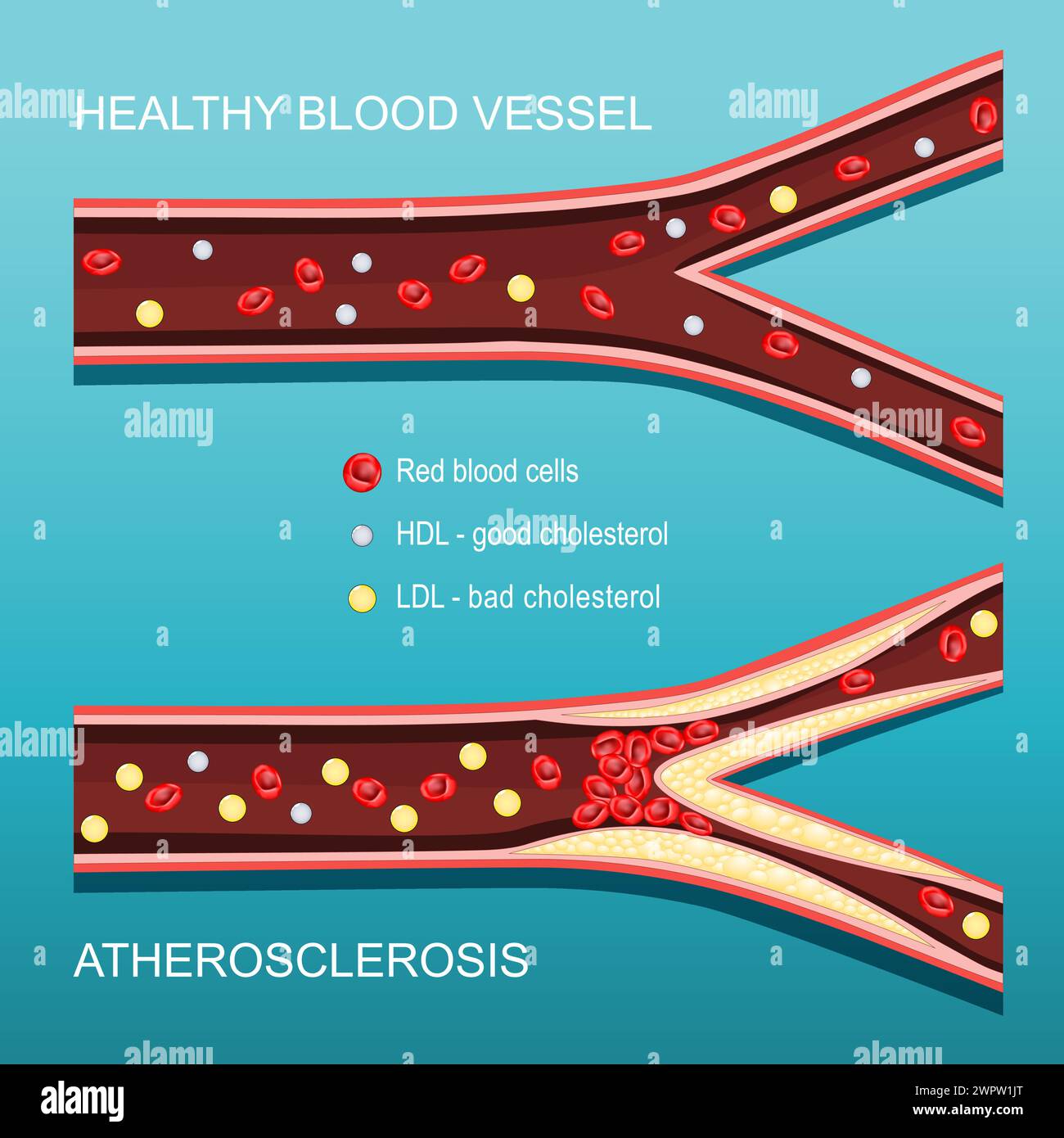 Atherosklerose. Cholesterinspiegel. Querschnitt einer Arterie mit roten Blutkörperchen, HDL, LDL und atheromatösen Plaques. Gutes und schlechtes Cholesterin. Vect Stock Vektor
