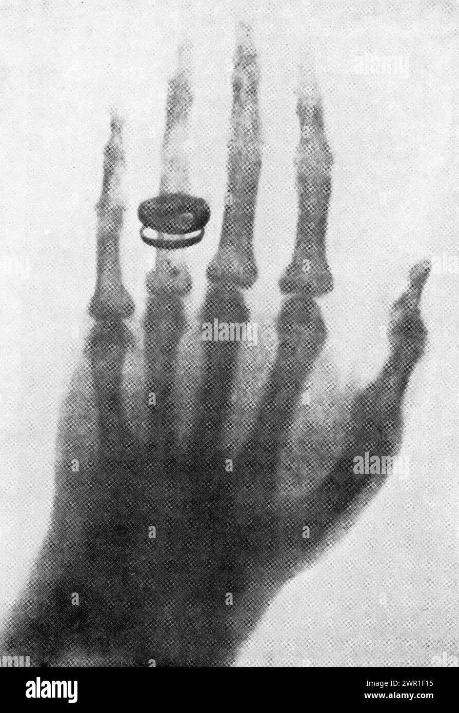 Ein Röntgenbild von Albert von Köllikers Hand, 1896. Von Wilhelm Röntgen (1845-1923). Wilhelm Conrad Röntgen war ein deutscher Maschinenbauingenieur und Physiker, der am 8. November 1895 elektromagnetische Strahlung in einem Wellenlängenbereich erzeugte und detektierte, der als Röntgen- oder Röntgenstrahlen bekannt war, was ihm 1901 den ersten Nobelpreis für Physik einbrachte. Stockfoto