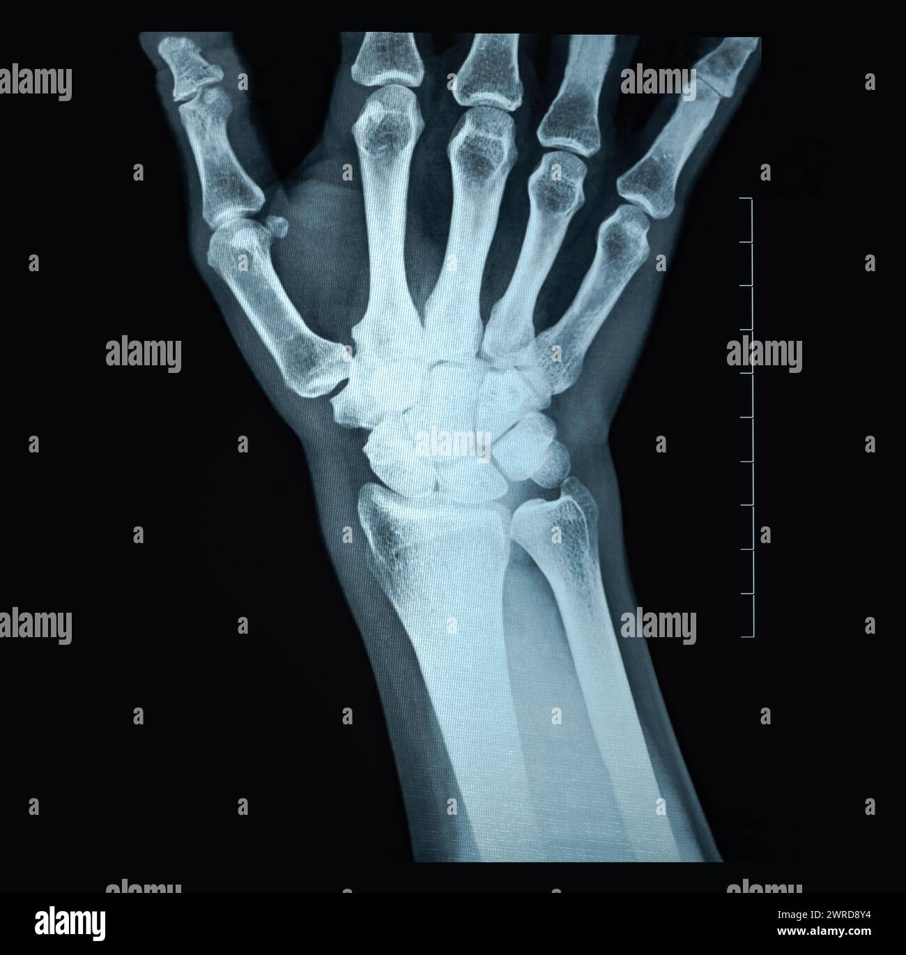 Lungenluxation Röntgenaufnahme der Vorderseite einer Frauenhand ungewöhnliches traumatisches Handgelenktrauma Stockfoto