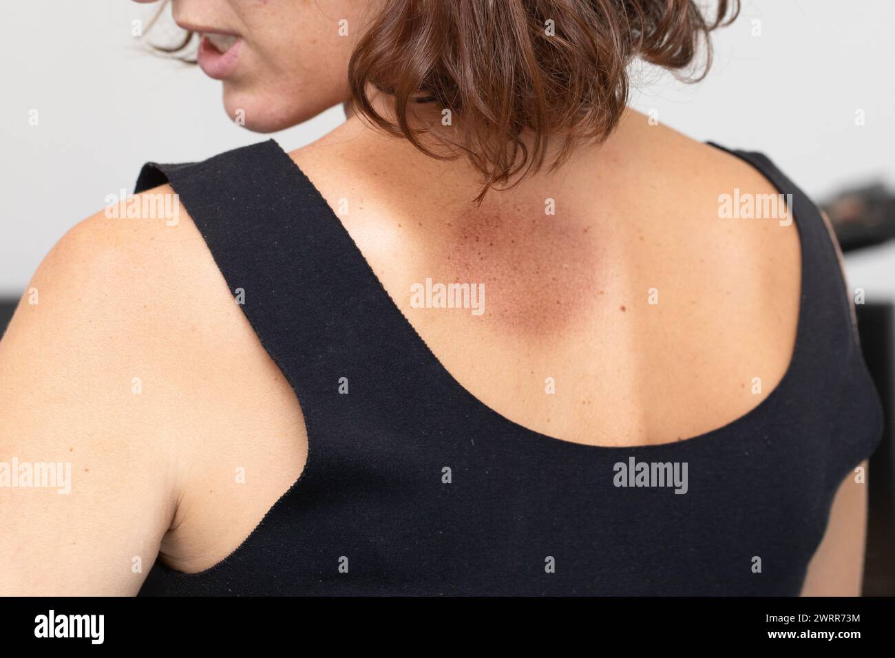 Über-Schulter-Ansicht einer Frau mit dermatologischen Flecken auf ihrer Haut, was auf einen möglichen Hautzustand hindeutet Stockfoto