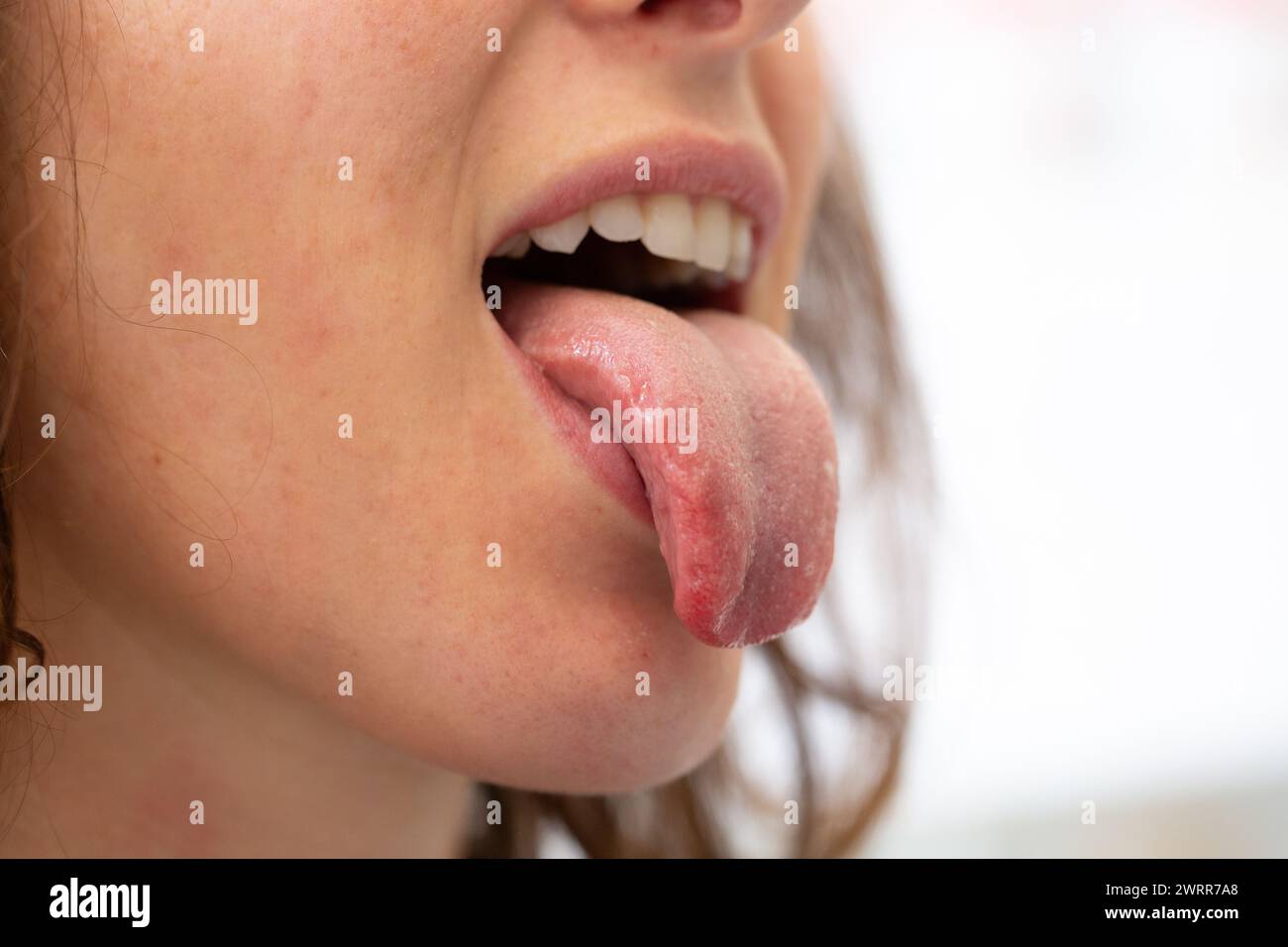 Nahaufnahme der Zunge einer Frau ausgestreckt, die Textur und Färbung zeigt, die auf einen Gesundheitszustand oder eine Reaktion hinweisen kann Stockfoto