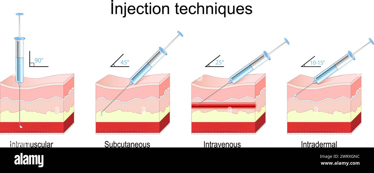 Injektionsmethoden. Querschnitt einer menschlichen Haut mit Spritze. Nadeleinführungswinkel für intramuskuläre, subkutane, intravenöse und intradermale i Stock Vektor