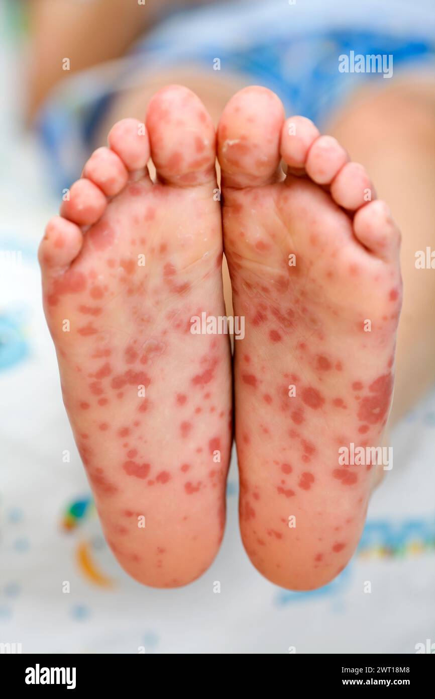 Hand-, Maul- und Klauenseuche (HFMD) / Singapur Grippe / Grippe Singapura Stockfoto