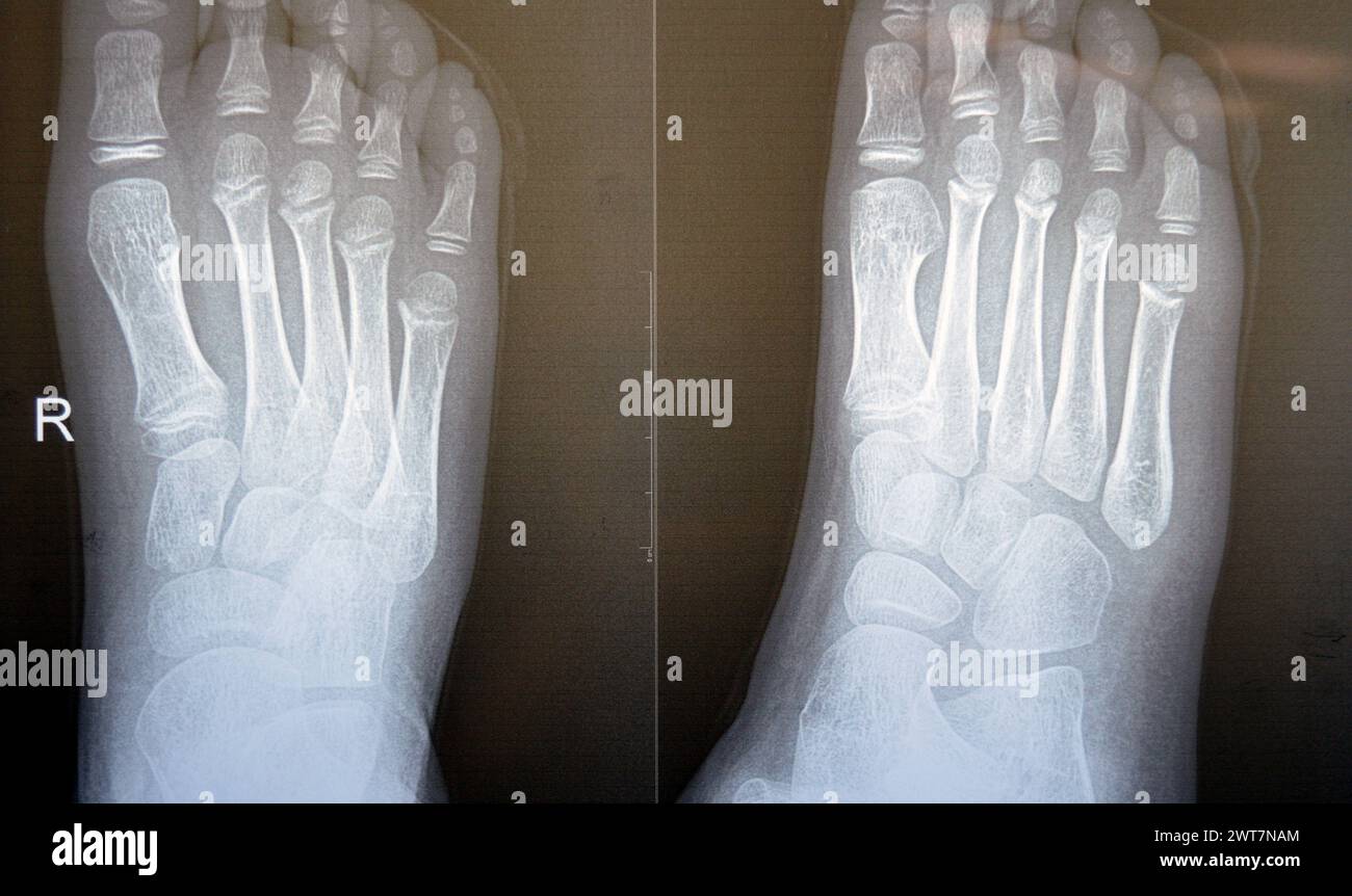 Das einfache Röntgenbild des rechten Fußes eines 9-jährigen Kindes zeigt eine normale pädiatrische Knochenröntgenuntersuchung mit Ossifikationszentren eines normal wachsenden Kindes mit Stockfoto