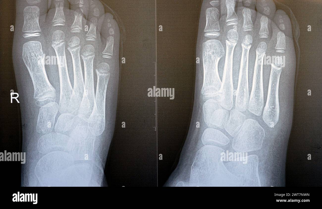 Das einfache Röntgenbild des rechten Fußes eines 9-jährigen Kindes zeigt eine normale pädiatrische Knochenröntgenuntersuchung mit Ossifikationszentren eines normal wachsenden Kindes mit Stockfoto