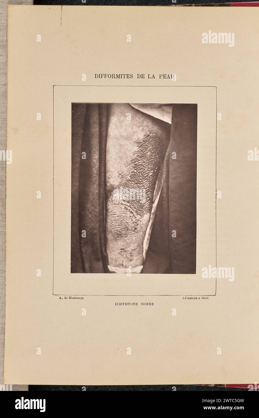 Ichthyose Noire. Arthur de Montmeja, Fotograf (französisch, geb. 1841) negativ um 1867, Druck 1882 Nahaufnahme eines Kniegelenkes und eines inneren Oberschenkels, der mit Ikyose bedeckt ist. (Recto, Halterung) oben in der Mitte, in schwarzer Tinte gedruckt: „DIFFORMITIES DE LA PEAU“ unten links, in schwarzer Tinte gedruckt: „A. de Montmeja“ unten in der Mitte, in schwarzer Tinte gedruckt: „ICHTHYOSE NOIRE“ unten rechts, in schwarzer Tinte gedruckt: „Ad naturam fecit“ Stockfoto