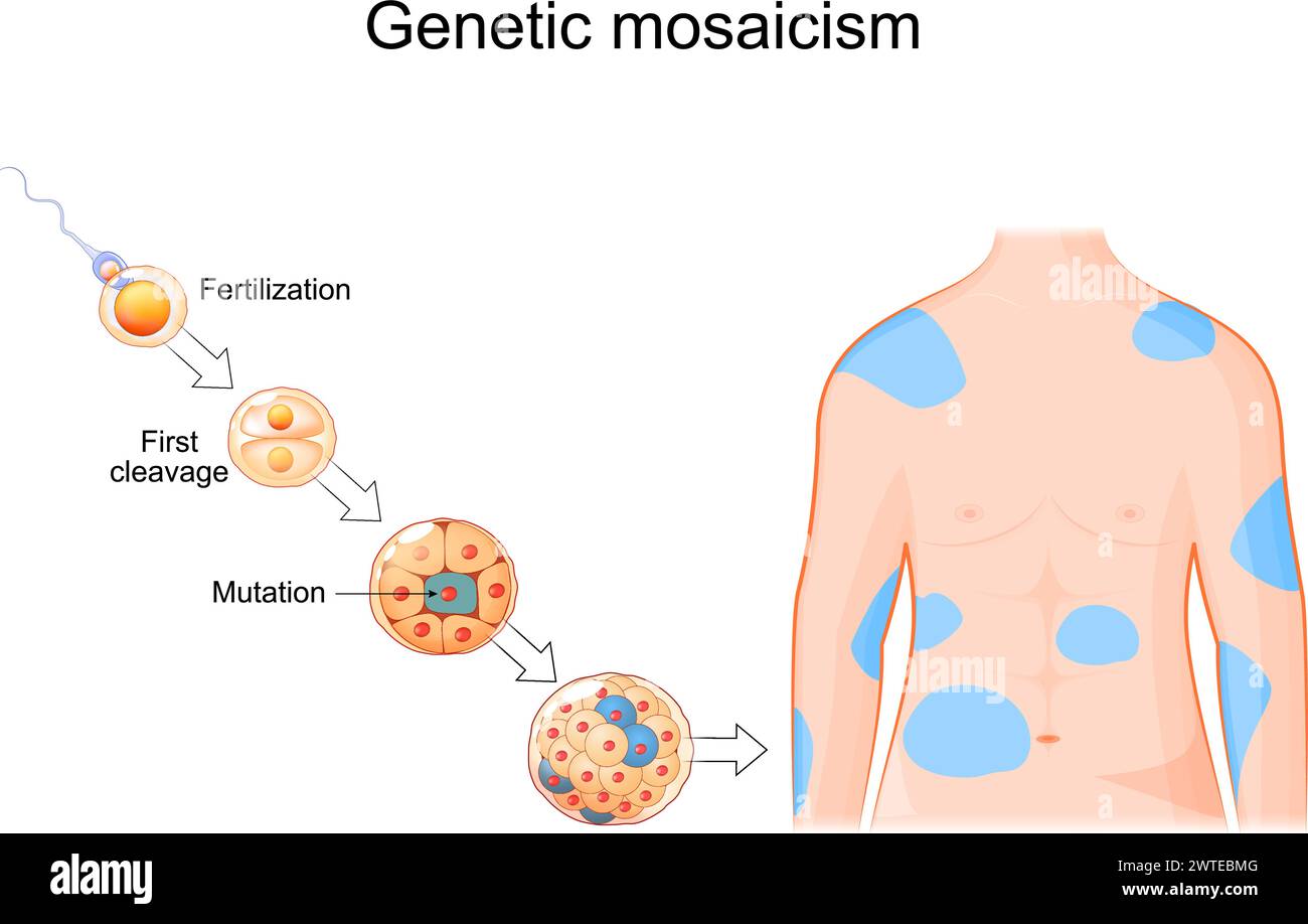 Genetischer Mosaik. Somatische Mutation. DNA-Replikationsfehler. Zellentwicklung von der Befruchtung zur Morula mit Mutation. Menschlicher Körper mit Betroffenen sind Stock Vektor