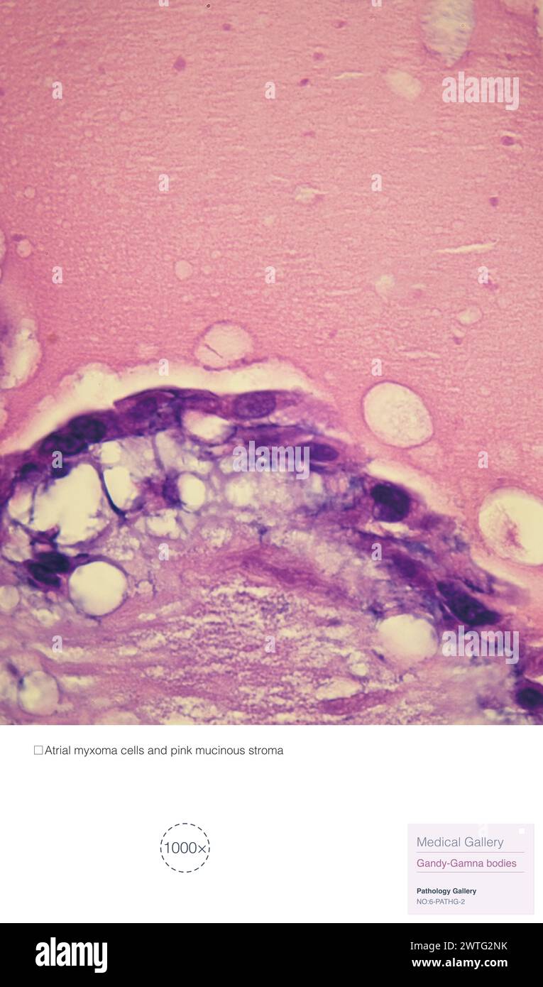 Pathologische Veränderungen beim Vorhofmyxom, dieses Bild zeigt Myxomzellen und rosa muzinöses Stroma. Das Vorhofmyxom ist ein gutartiger Tumor des Herzens. Stockfoto