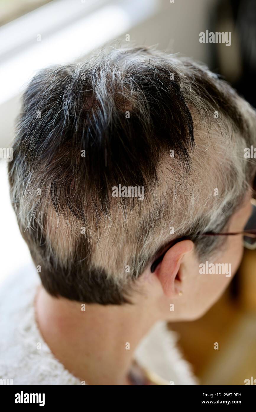 Frau mit Alopezie Stockfoto