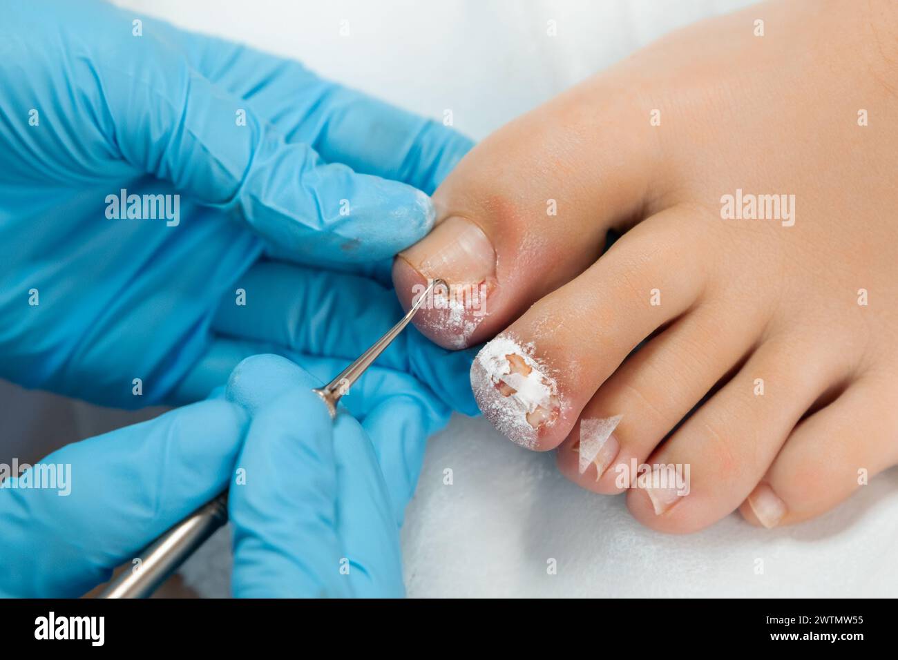 Podologe in blauen Handschuhen, die medizinische Behandlung an weiblichen Zehen im medizinischen Zentrum durchführen. Stockfoto