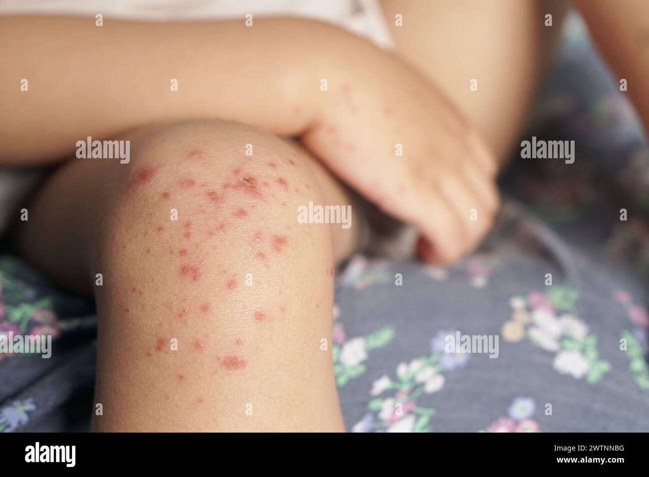 Nahaufnahme des Kniegelenkes des Kindes, das mit einer Hand-Fuß-Mund-Krankheit oder HFMD von Enterovirus oder Coxsackie-Virus infiziert ist, rot auf der Haut Stockfoto