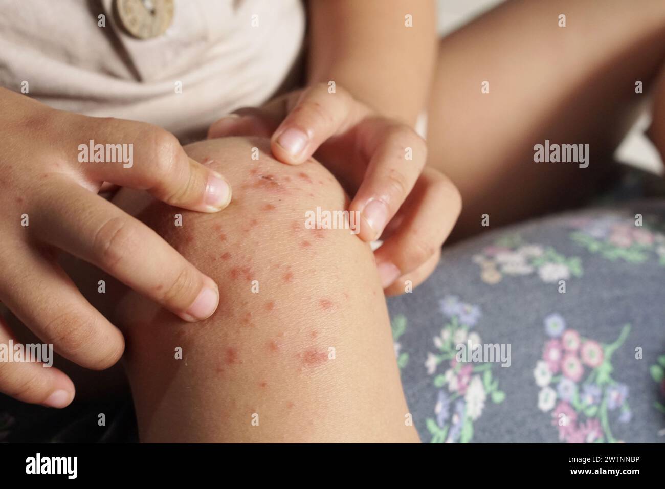 Nahaufnahme eines Jungen, der sein Knie mit einer Hand-Fuß-Mund-Krankheit oder HFMD von Enterovirus oder Coxsackie-Virus infiziert hat; Stockfoto