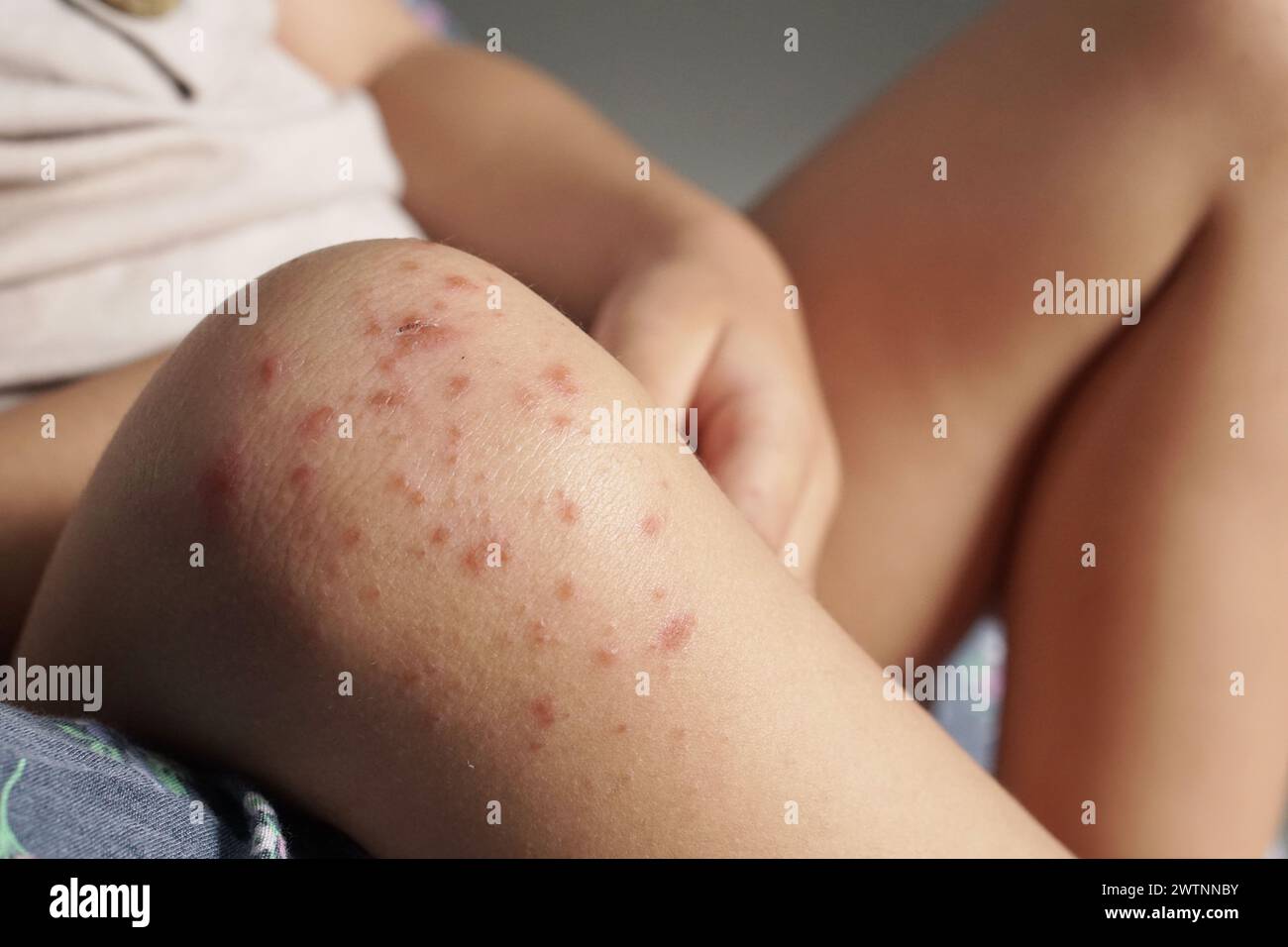 Nahaufnahme des Kniegelenkes des Kindes, das mit einer Hand-Fuß-Mund-Krankheit oder HFMD infiziert ist, die vom Enterovirus oder Coxsackie-Virus stammt, Nahansicht Zoom sh Stockfoto