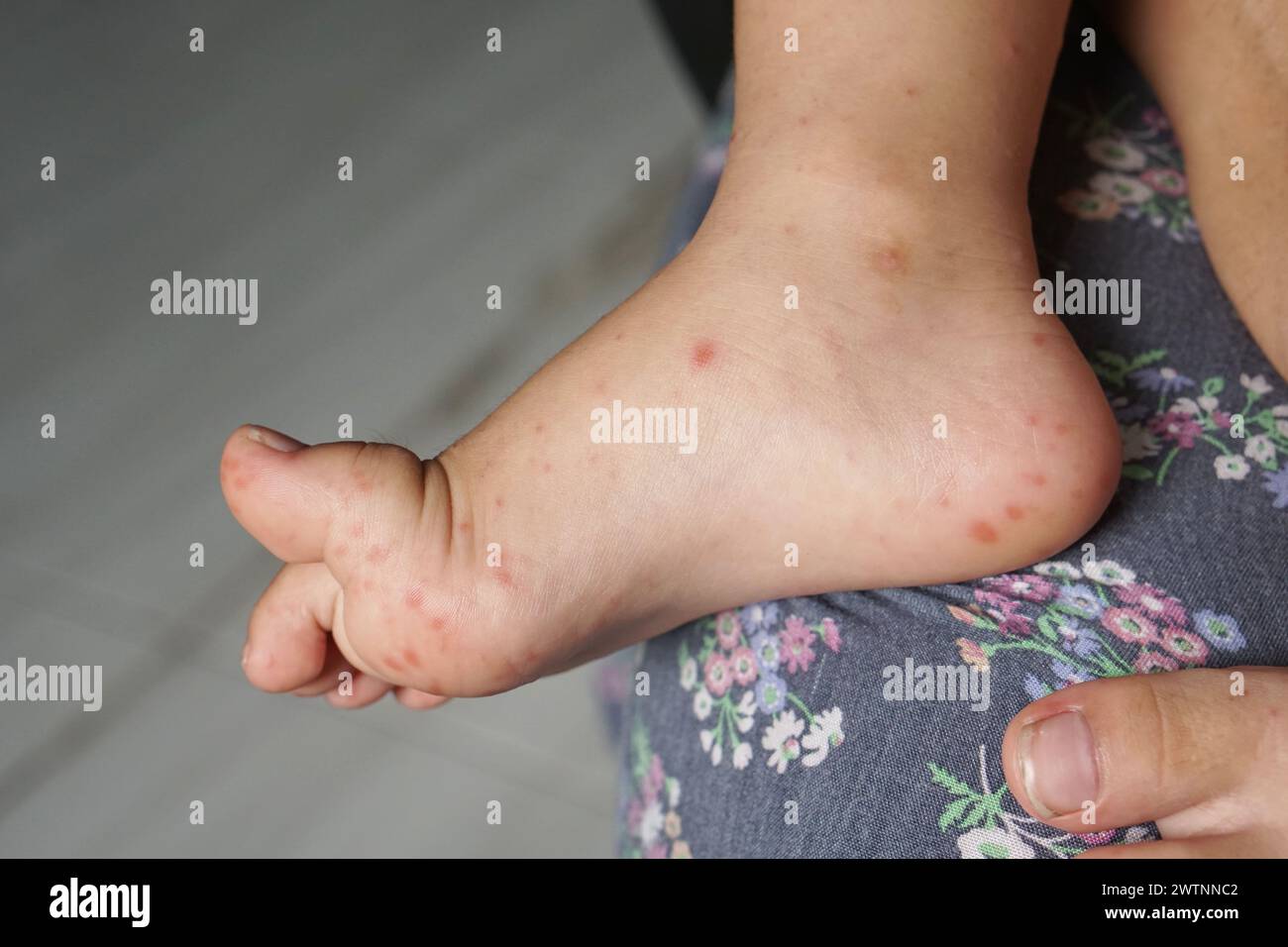 Nahaufnahme von Kinderfüßen, die mit Hand Fuß- und Mundkrankheit oder HFMD infiziert sind, die von Enterovirus oder Coxsackie-Virus stammen, Nahansicht Zoom sh Stockfoto