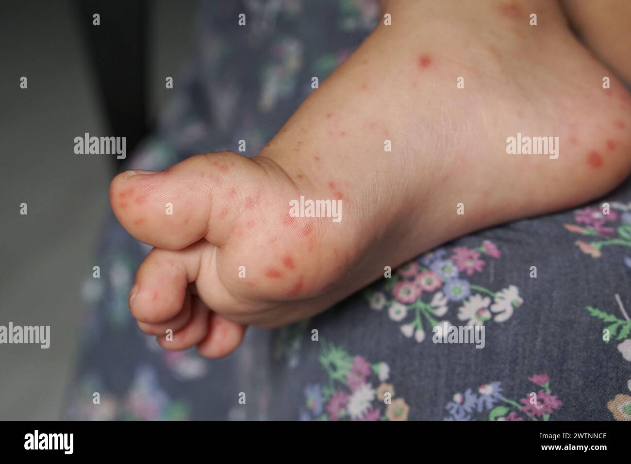 Nahaufnahme von Kinderfüßen, die mit Hand Fuß- und Mundkrankheit oder HFMD infiziert sind, die von Enterovirus oder Coxsackie-Virus stammen, Nahansicht Zoom sh Stockfoto
