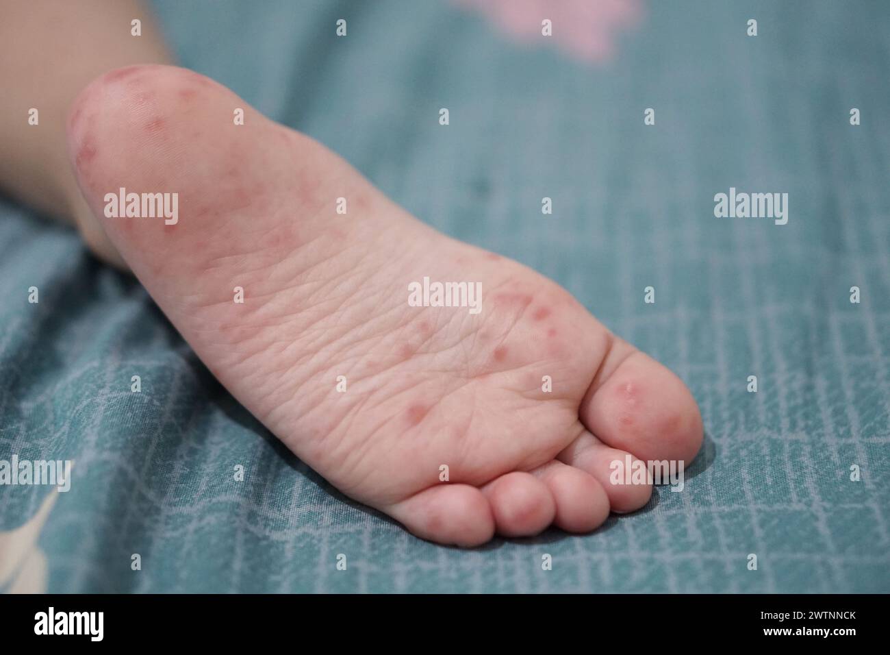 Nahaufnahme von Kinderfüßen, die mit einer Hand-Fuß-Mund-Krankheit oder HFMD von Enterovirus oder Coxsackie-Virus infiziert sind, Zoomaufnahme. Stockfoto