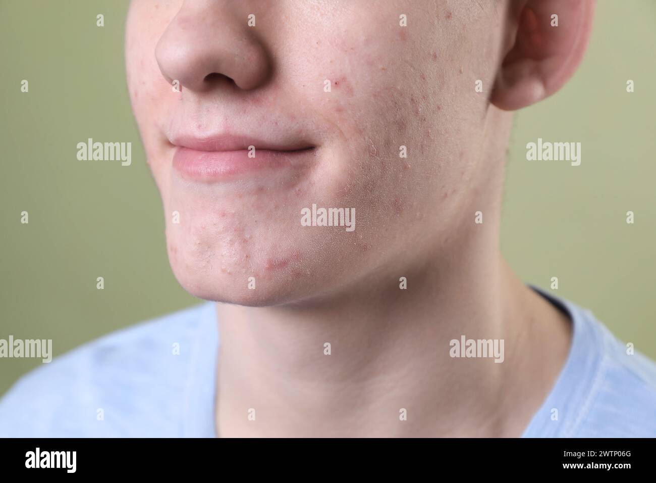 Junger Mann mit Akne-Problem auf olivem Hintergrund, Nahaufnahme Stockfoto