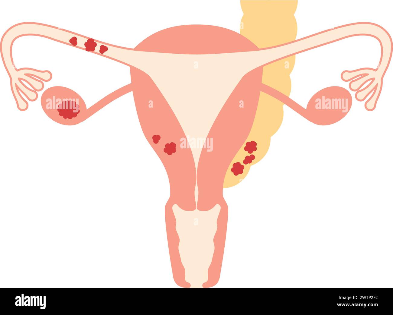 Entfernung Der Gebärmutter Und Der Eierstöcke www.alamy.de