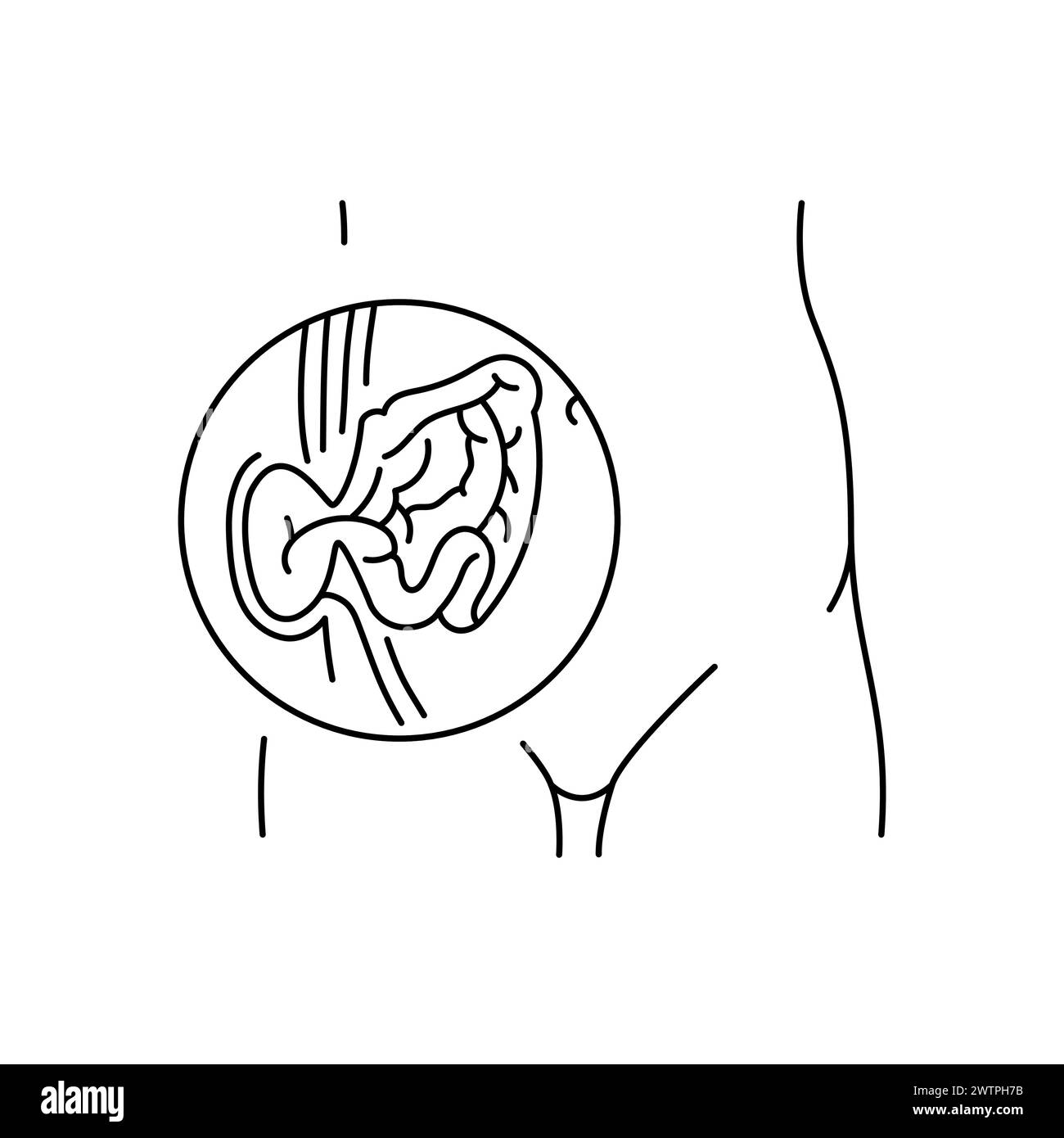 Strangulierte Hernienlinie. Vektorisoliertes Element. Bearbeitbare Kontur. Stock Vektor