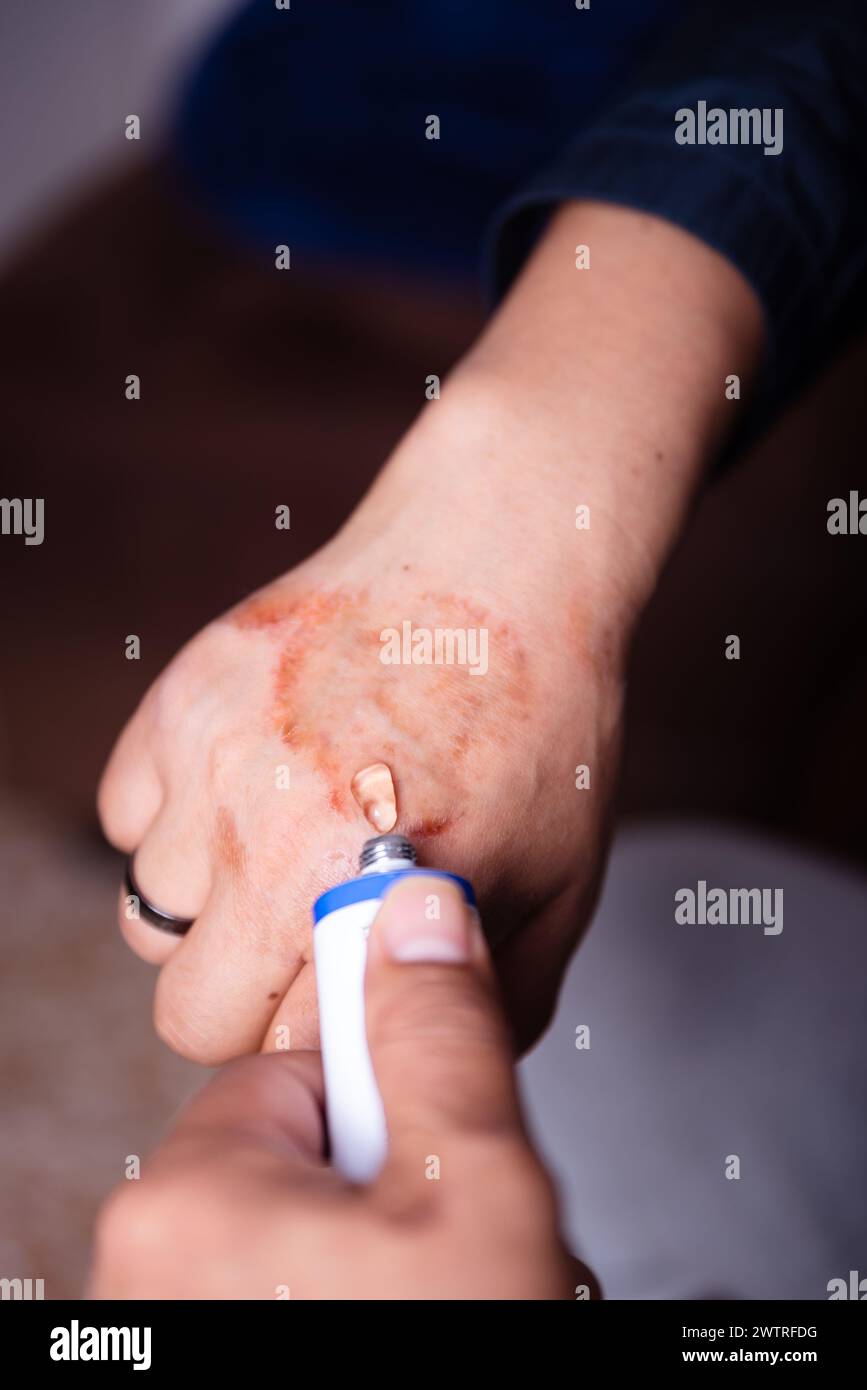 Anwendung einer Creme auf die Hand einer nicht erkennbaren Person mit allergischer Hautreaktion. Stockfoto