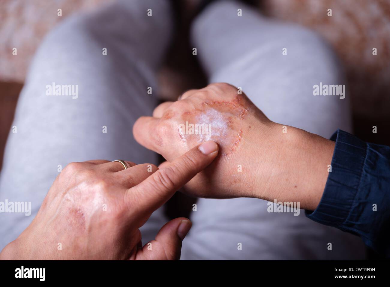 Anwendung einer Creme auf die Hand einer nicht erkennbaren Person mit allergischer Hautreaktion. Stockfoto