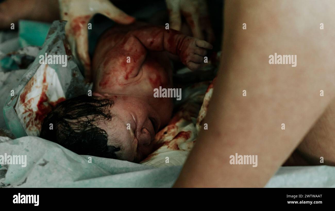 Authentisches Geburtsbild - Ein weinendes neugeborenes Mädchen mit dunklen Haaren, die kurz nach der Geburt mit Blut bedeckt sind. Die Nabelschnur ist noch befestigt. Stockfoto