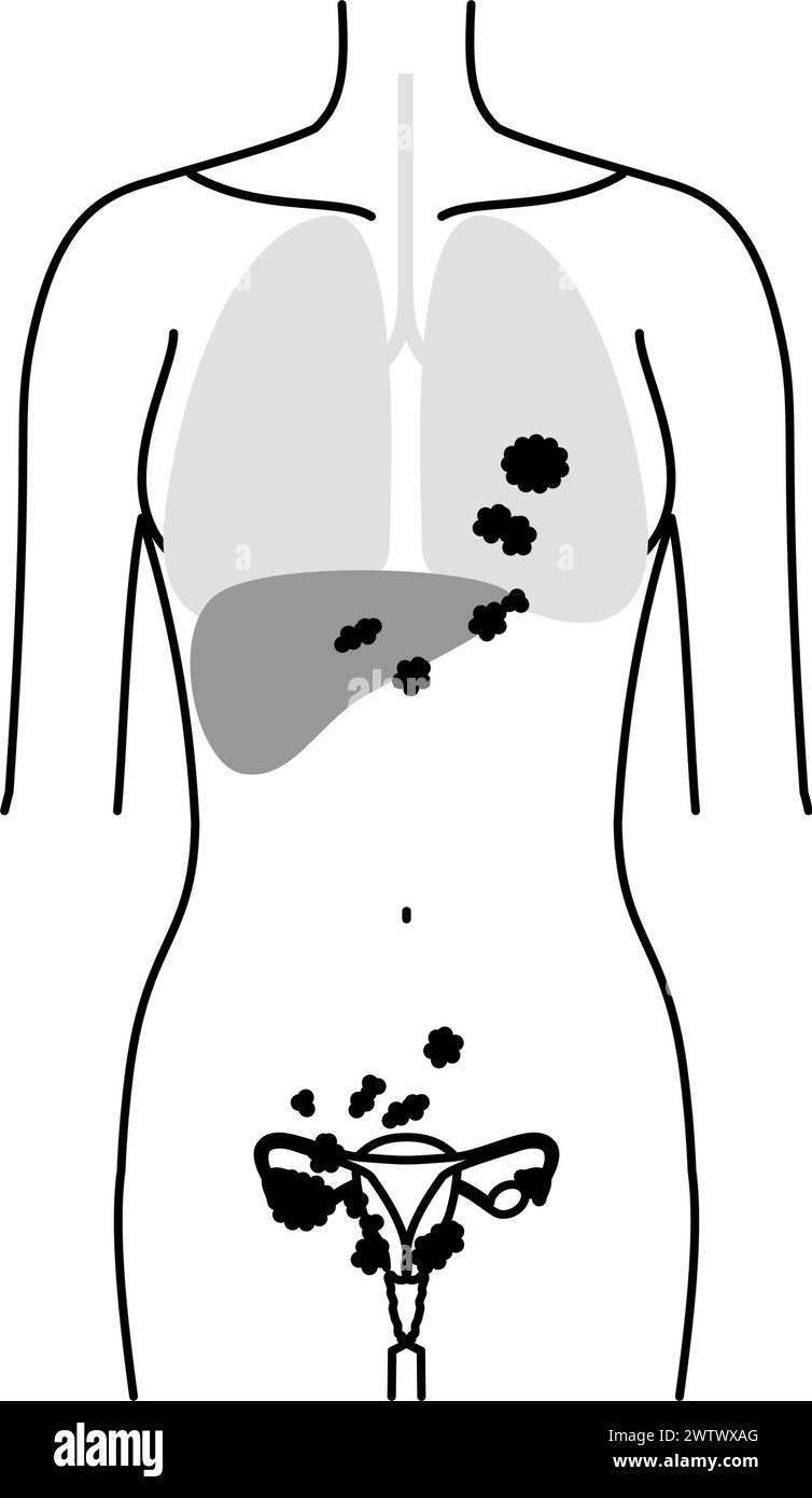 Schematische Darstellung des Ovarialkarzinoms im Stadium IV, Anatomie der Gebärmutter und der Eierstöcke, Anatomie der Gebärmutter und der Eierstöcke - Übersetzung: Krebs hat s Stock Vektor