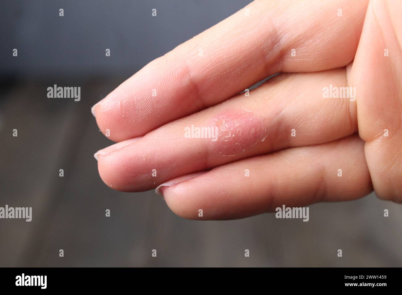 Ein roter Fleck an den Fingern. Hautkrankheiten. Die Behandlung der Haut der Hände. Gesunde Haut. Stockfoto