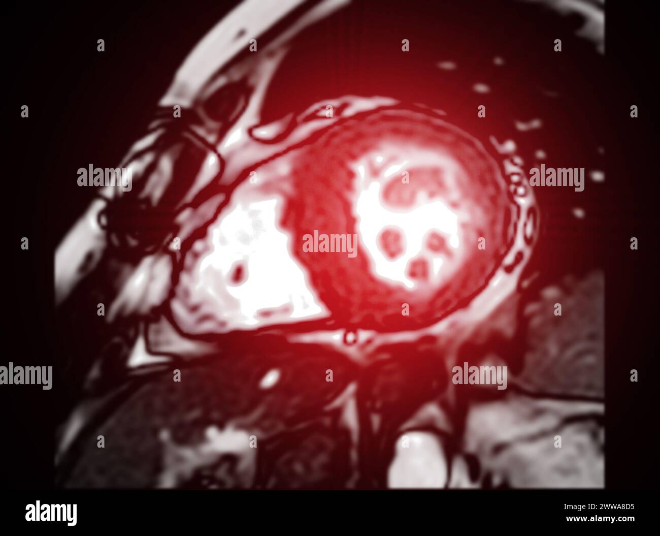 Die kardiale MRT bewertet die Herzgesundheit und liefert detaillierte Bilder für die Diagnose kardiovaskulärer Erkrankungen und die Planung der Behandlung Stockfoto