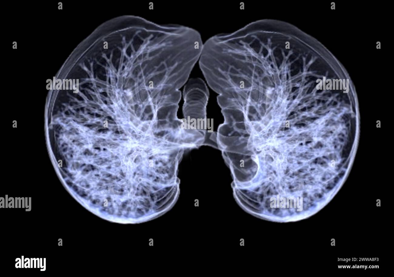 CT-3D-Darstellung von Brust oder Lunge mit Trachea und Lunge im Respirationssystem. Stockfoto