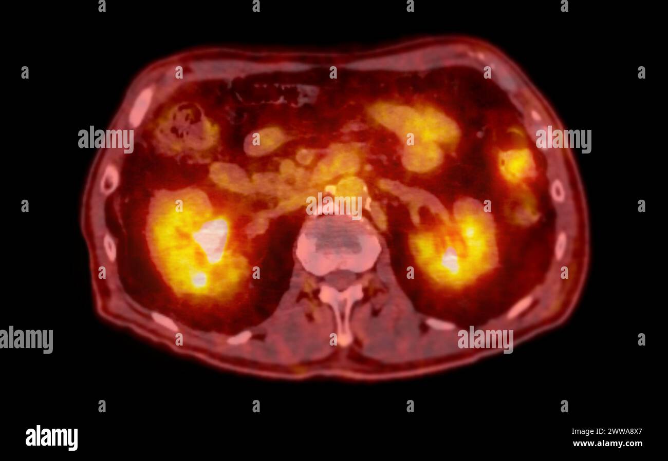 Ein PET-CT-Scan-Bild ist eine diagnostische Visualisierung, die Positronen-Emissions-Tomographie (PET) und Computertomographie (CT) kombiniert, um eine bessere Erkennung zu ermöglichen Stockfoto