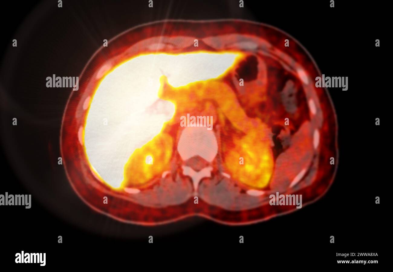 Ein PET-CT-Scan-Bild ist eine diagnostische Visualisierung, die Positronen-Emissions-Tomographie (PET) und Computertomographie (CT) kombiniert, um eine bessere Erkennung zu ermöglichen Stockfoto