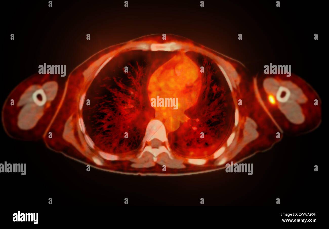 Ein PET-CT-Scan-Bild ist eine diagnostische Visualisierung, die Positronen-Emissions-Tomographie (PET) und Computertomographie (CT) kombiniert, um eine bessere Erkennung zu ermöglichen Stockfoto