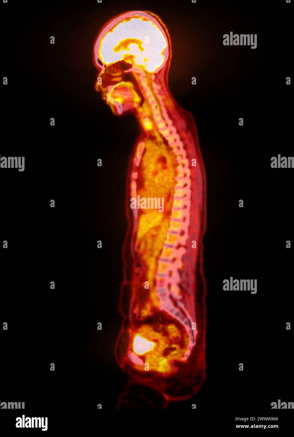 Ein PET-CT-Scan-Bild ist eine diagnostische Visualisierung, die Positronen-Emissions-Tomographie (PET) und Computertomographie (CT) kombiniert, um eine bessere Erkennung zu ermöglichen Stockfoto