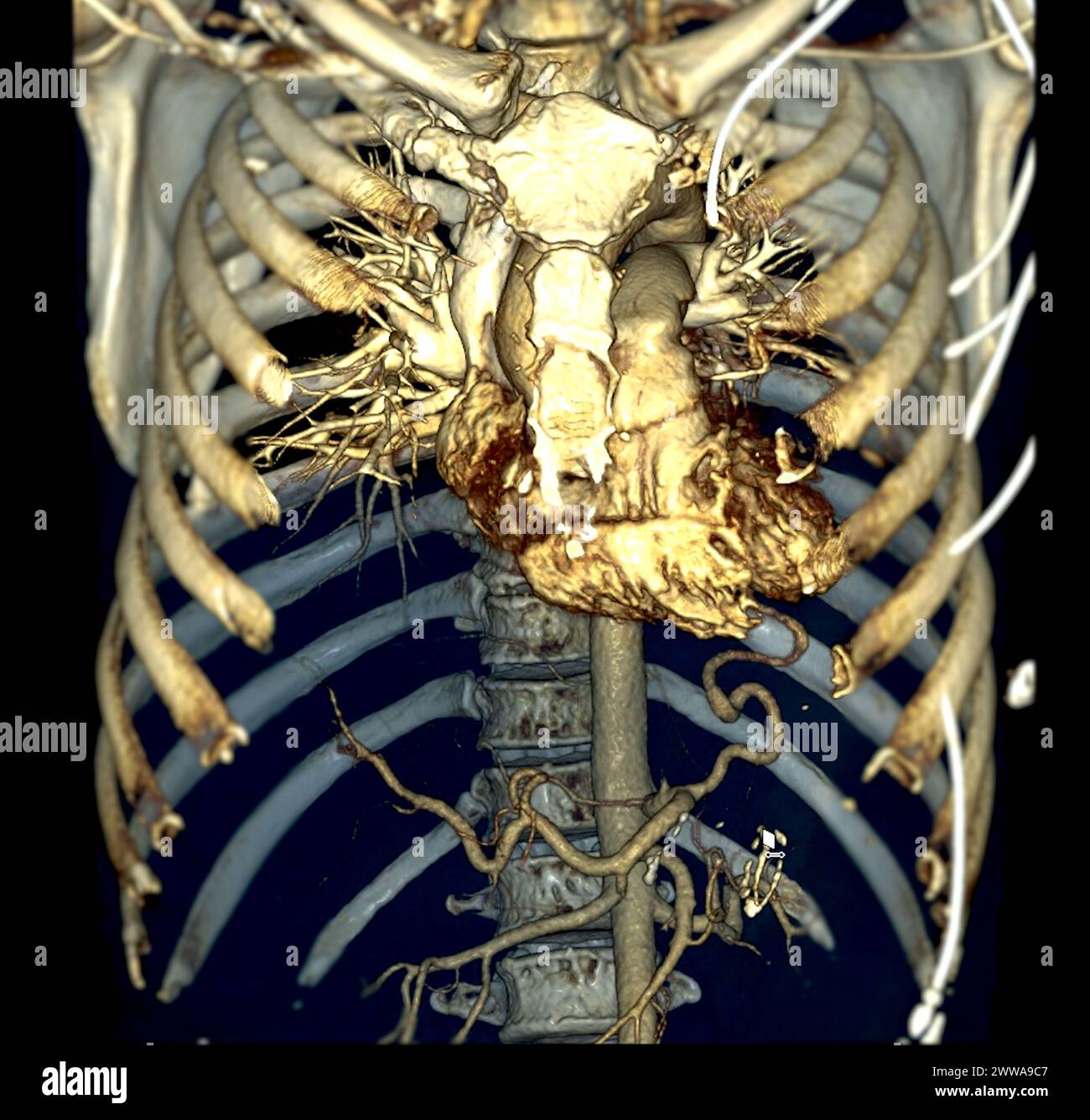 CTA 3D-Rendering der thorakalen Aorta bietet eine detaillierte Visualisierung und liefert klare Einblicke in die Anatomie, Pathologie und die umgebenden Strukturen der Aorten für Stockfoto