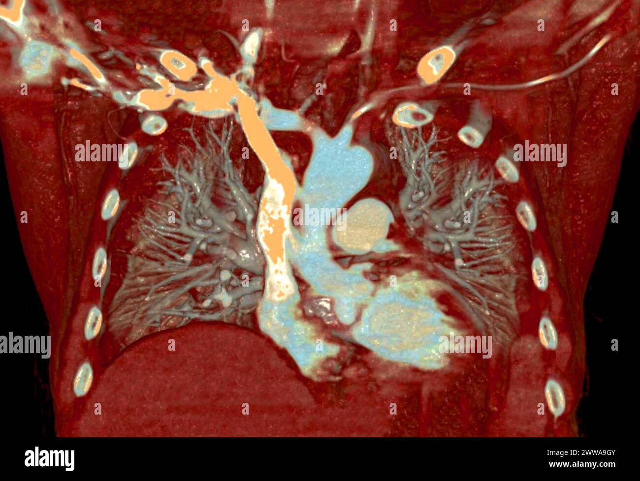 CTA 3D-Rendering der thorakalen Aorta bietet eine detaillierte Visualisierung und liefert klare Einblicke in die Anatomie, Pathologie und die umgebenden Strukturen der Aorten für Stockfoto