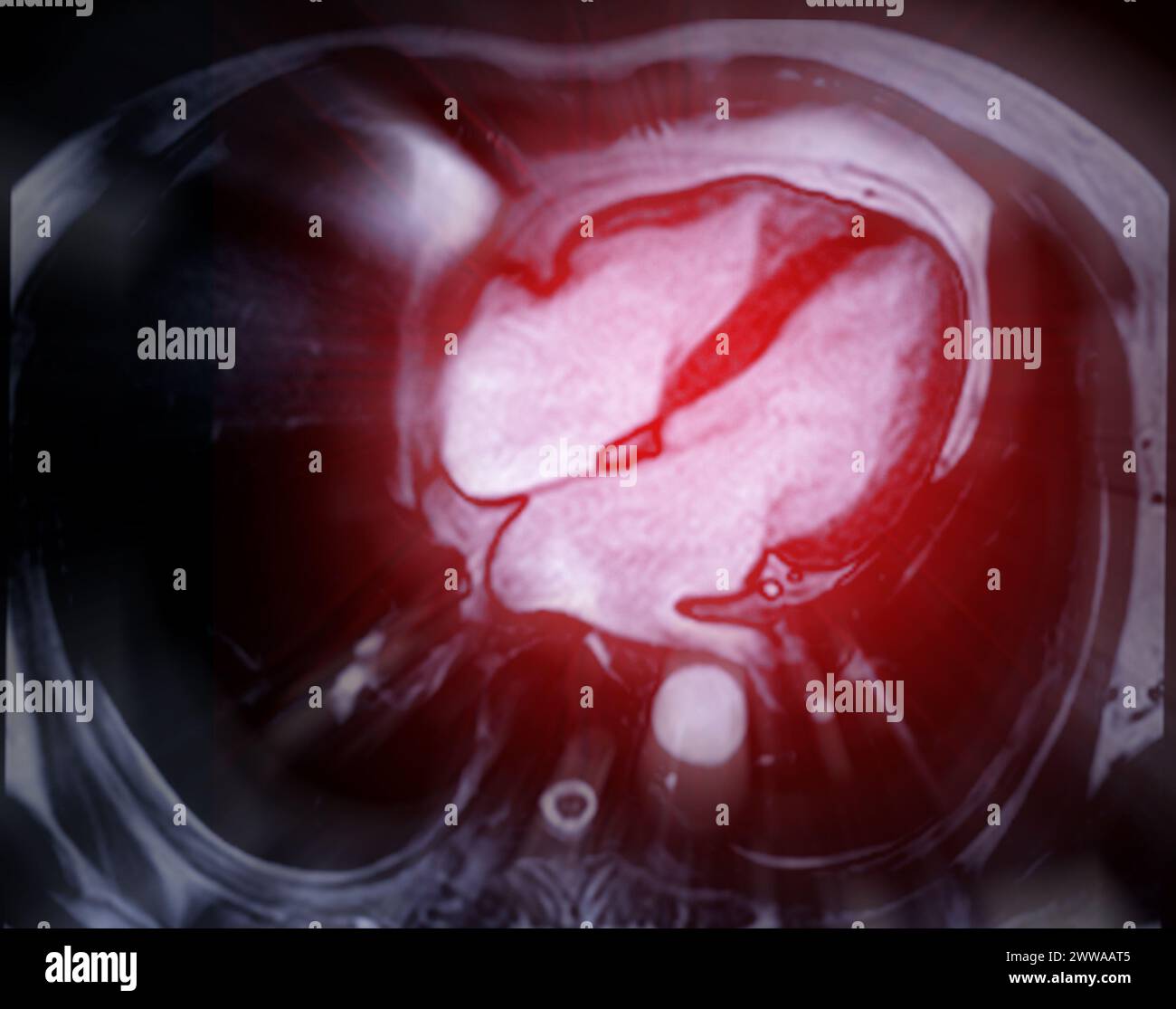 Kardiale MRT-Bilder sind entscheidend für die Beurteilung der Herzgesundheit, die Identifizierung von Herzfehlbildungen und die Orientierung an Behandlungsplänen. Stockfoto