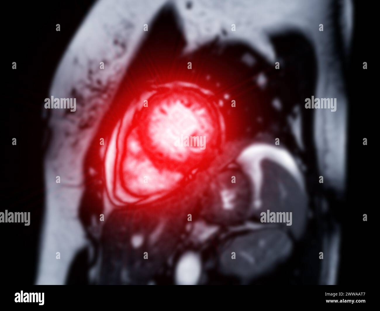 Kardiale MRT-Bilder sind entscheidend für die Beurteilung der Herzgesundheit, die Identifizierung von Herzfehlbildungen und die Orientierung an Behandlungsplänen. Stockfoto