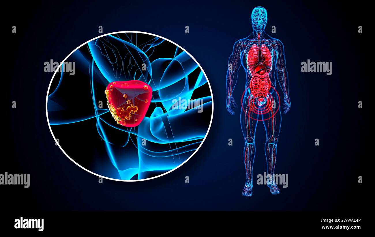 Prostatakarzinom, konzeptuelle Illustration. Stockfoto