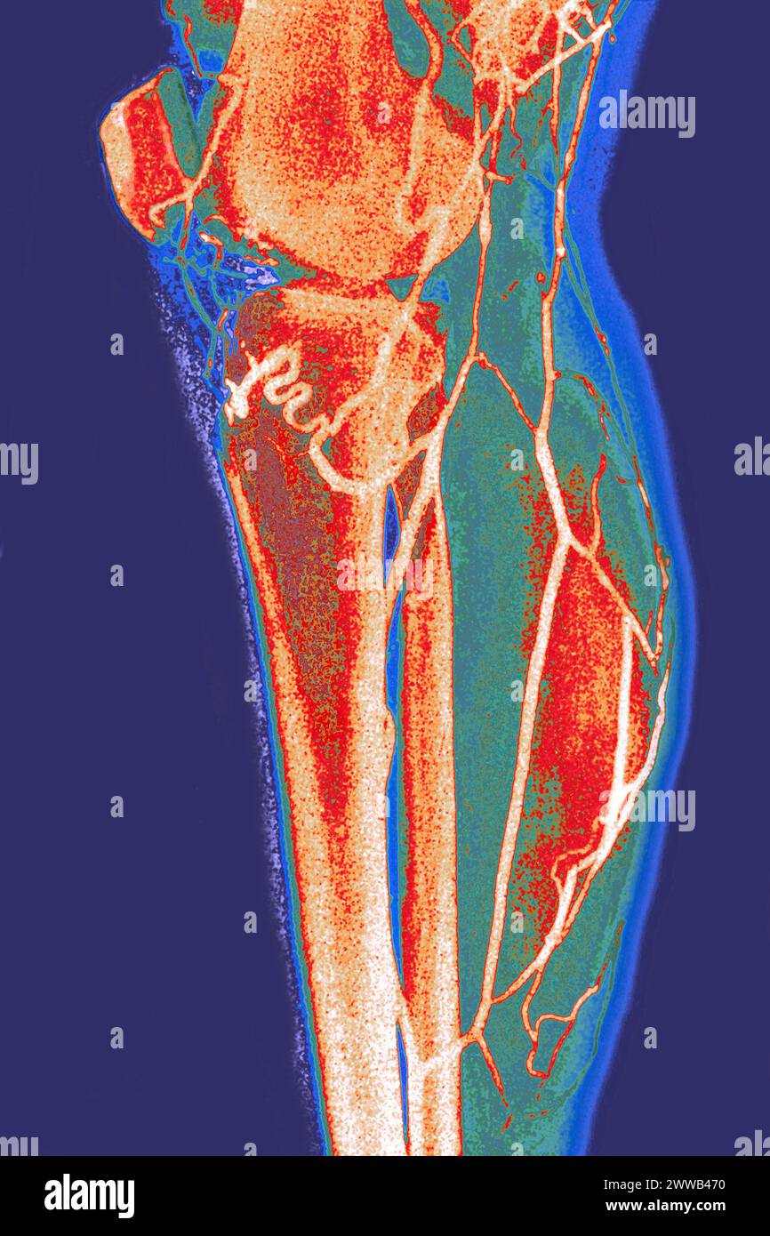 Arteriographie oder Angiographie (radiologische Untersuchung der Arterien einer unteren Extremität im Profil). Stockfoto