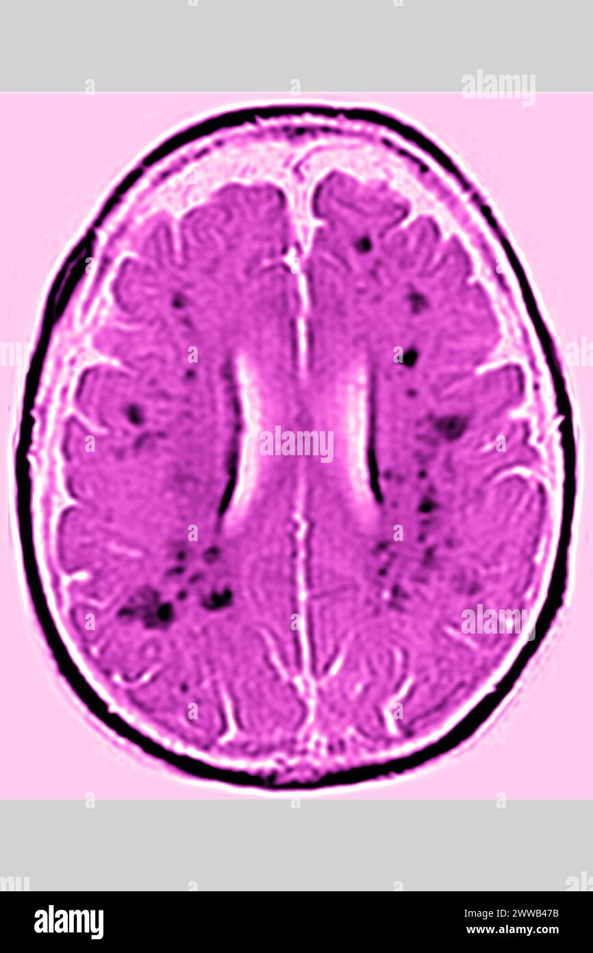 Leukoaraiose (Schädigung der kleinen Gefässe der zerebralen weißen Substanz vaskulärer Herkunft bei älteren Menschen). Radiale zerebrale MRT im Radialschnitt. Stockfoto