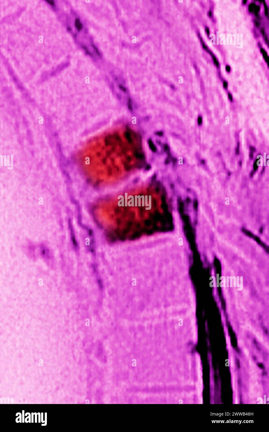 Vertebrale Osteitis (Entzündung des Knochengewebes zweier Rückenwirbel, verursacht durch eine bakterielle Infektion). Stockfoto