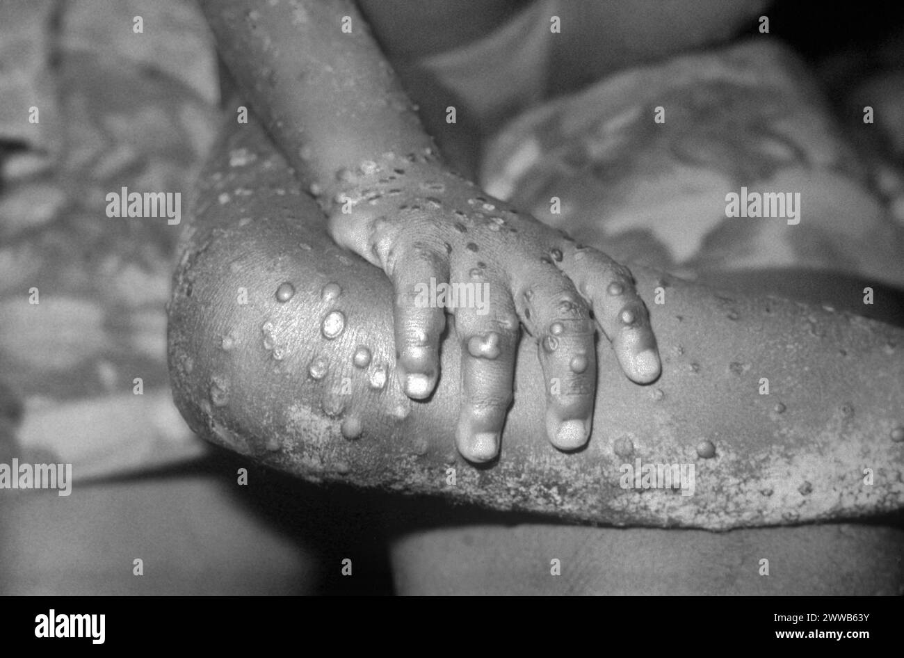 Ansicht der rechten Hand und des Beines eines 4-jährigen Mädchens in Bondua, Grand Gedeh County, Liberia, mit zahlreichen makulopapulösen Läsionen von Affenpocken. Stockfoto