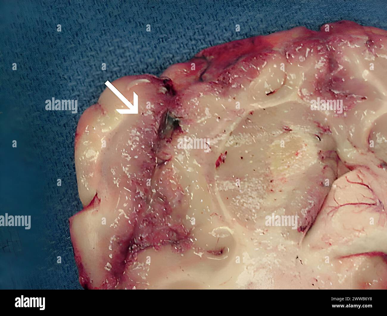 Fokale Blutung und Nekrose der Frontalrinde durch Naegleria fowleri. Stockfoto