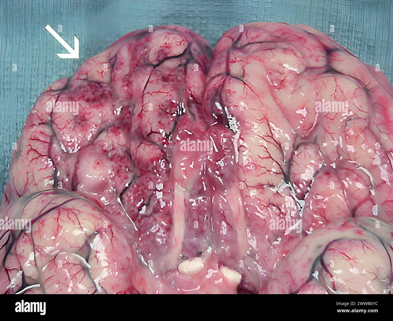Ausgedehnte Blutungen und Nekrosen liegen im Gehirn vor, vor allem in der Frontalrinde. Stockfoto