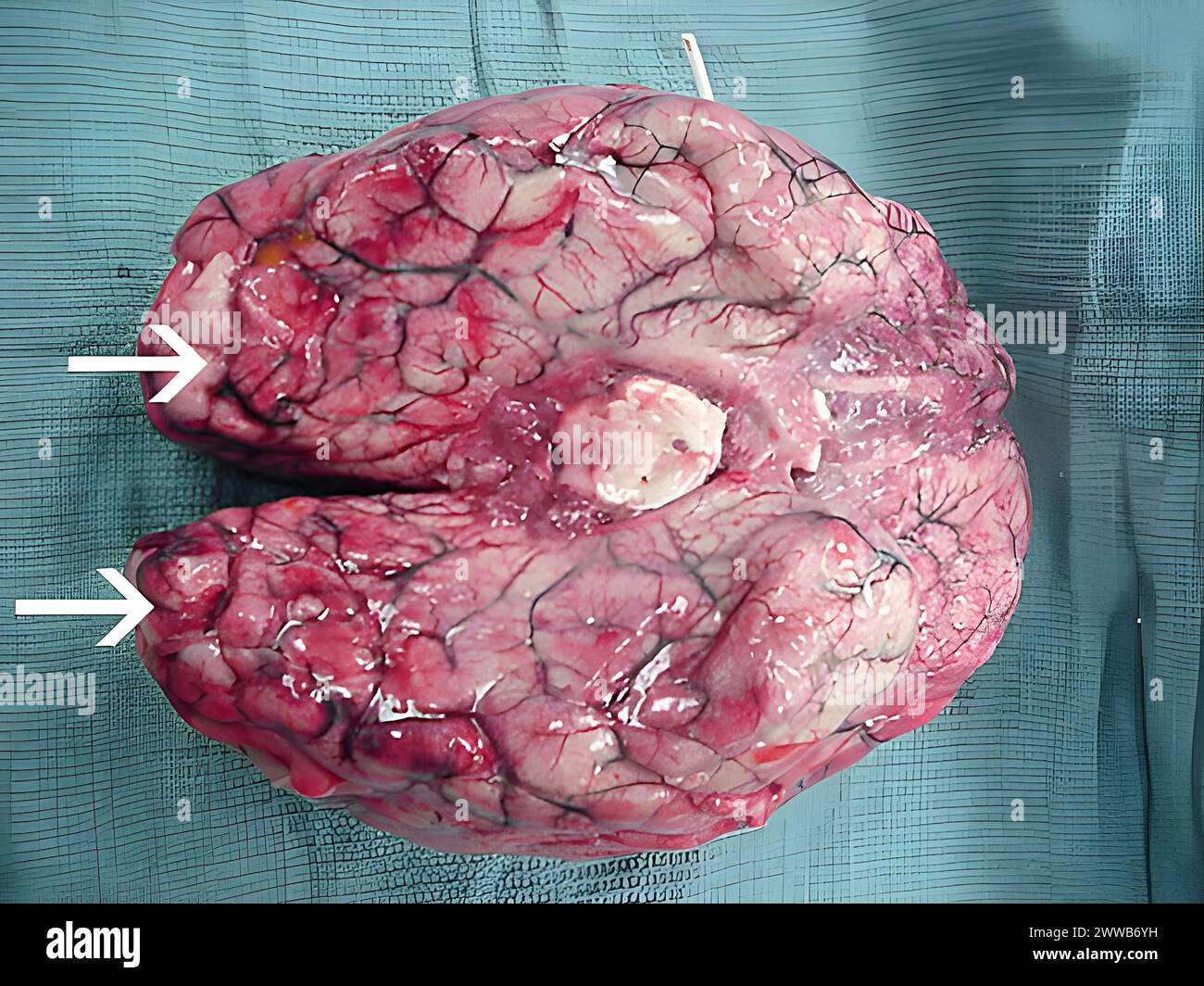Ausgedehnte Blutungen und Nekrosen liegen im Gehirn vor, vor allem in der Frontalrinde. Stockfoto